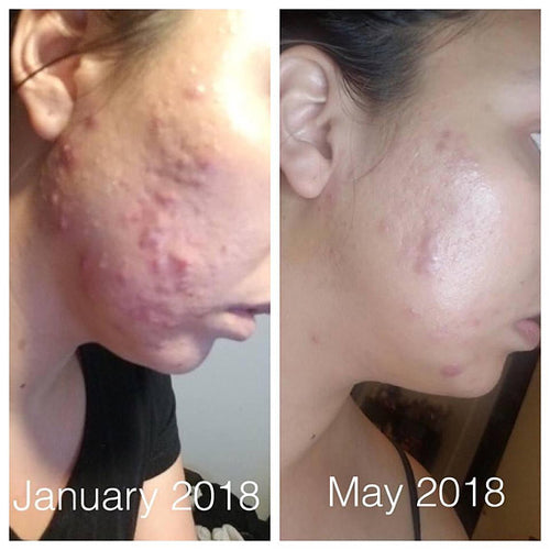 Rapid Acne Repair Treatment