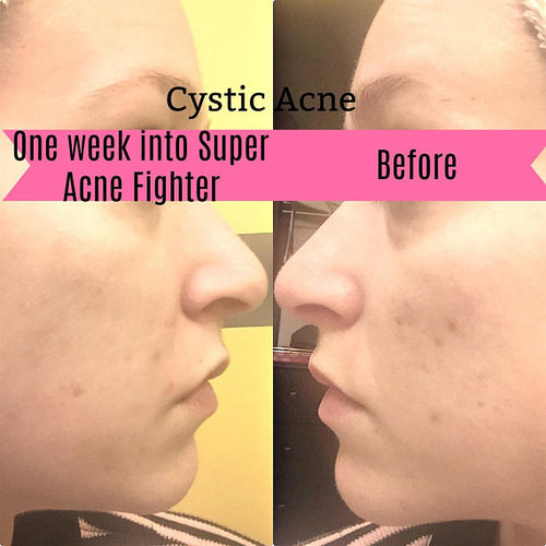 Rapid Acne Repair Treatment