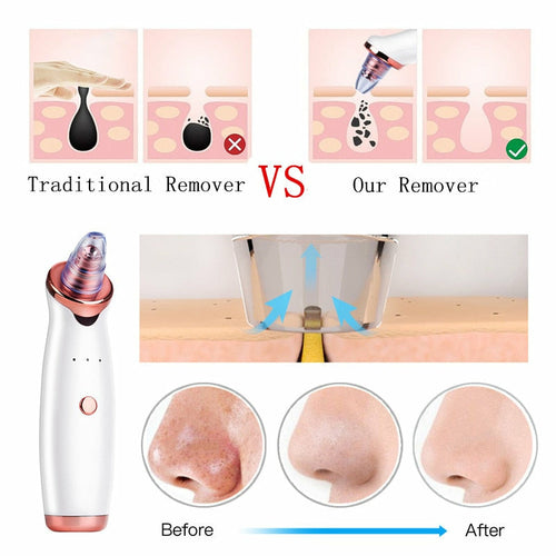 Blackhead Remover Vacuum Pro